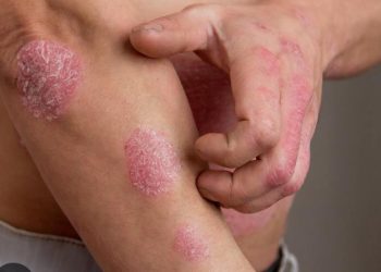 Moras Lahadaet Kontinua Aumenta iha TL